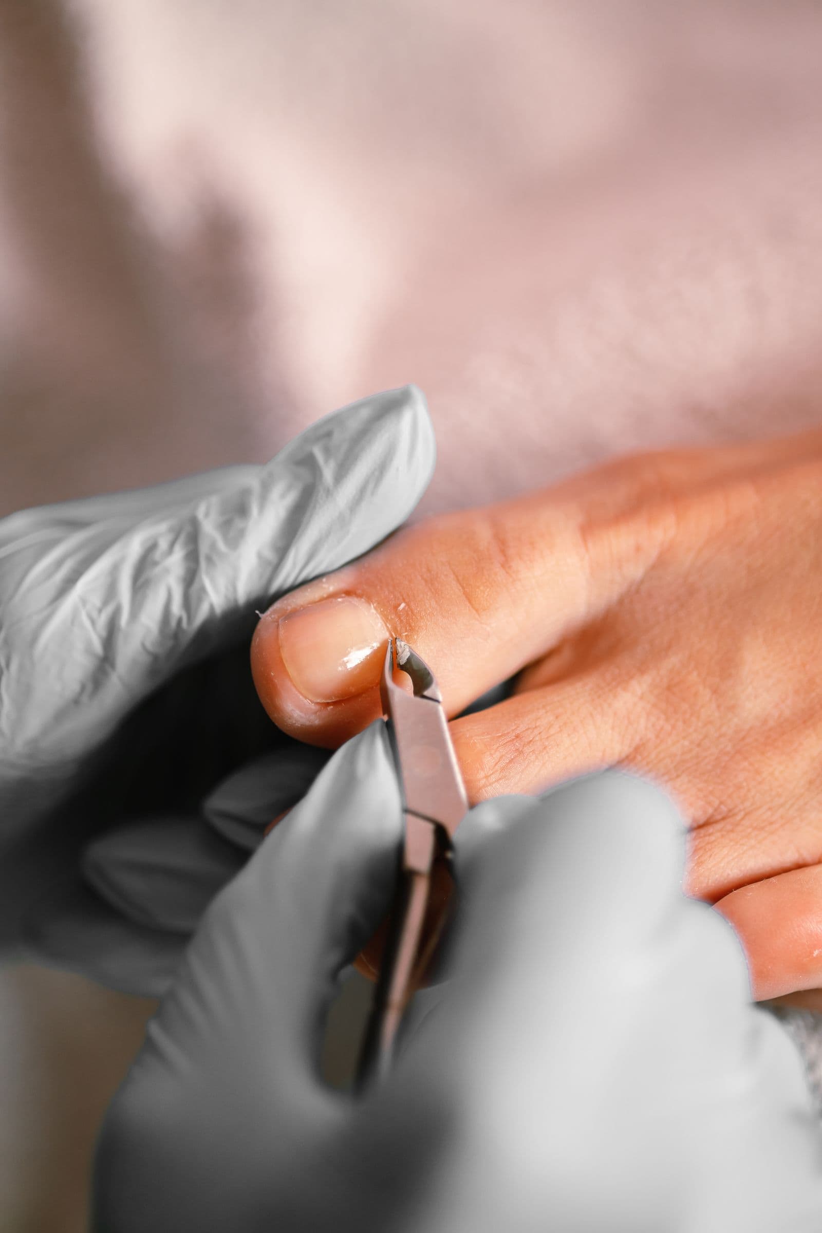 Därför uppstår nageltrång — och så fungerar Onyfix